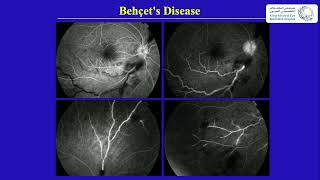 Behcets Disease [upl. by Baram]