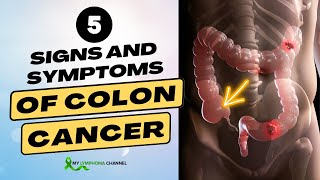 5 Signs and Symptoms of Colon Cancer [upl. by Chick581]