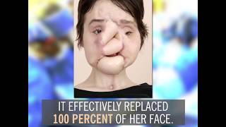 Katie Stubblefields Face Transplant  By the Numbers [upl. by Karole]