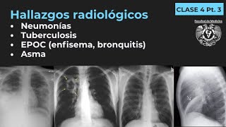 043  Neumonía TB EPOC Enfisema Bronquitis Bronquiectasias Asma [upl. by Liatrice]