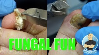 EXTREME BAD NAIL FUNGUS TREATMENT 1  FOOT HEALTH MONTH 2018 17 [upl. by Anella781]