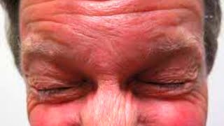 What is Blepharospasm Symptoms Causes Treatment [upl. by Doro]