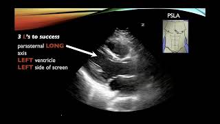 Basic Cardiac Ultrasound Views and Pathology  Echocardiography [upl. by Madonna]