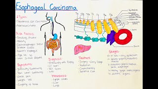 Esophageal Cancer  What you need to know [upl. by Lothar]