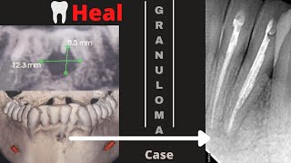 How To Treat Periapical Granuloma ReRoot canal of Phoenix abscess  Healing of Periapical lesion [upl. by Onez]