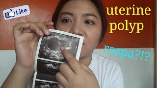 PCOS Journey Ep 2  Bakit ako niraspa [upl. by Tohcnarf81]