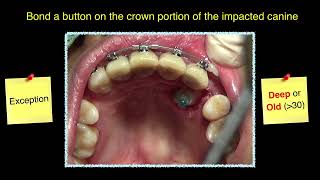 CC401 Adult Palatally Impacted Cuspid Step by Step [upl. by Mellar365]