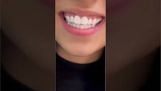 Artificial Tooth caps 😍youtubeshortsshortstrending [upl. by Anoit94]