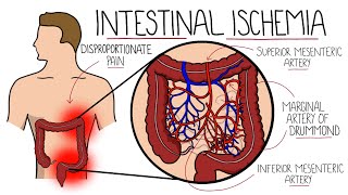 Intestinal Ischemia  Mesenteric Ischemia Acute amp Chronic amp Ischemic Colitis [upl. by Keligot]