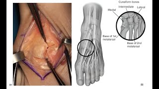 Lisfranc Joint Exposure Expert Reveals the Hidden Dangers [upl. by Holmun]