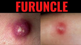 What is Furuncle Furuncle Boil DefinitionCauses Symptoms Risk Factors USMLE [upl. by Parks]