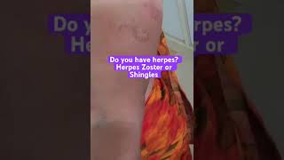 Herpes Zoster or Shingles medicine now Available ✅ [upl. by Delano65]