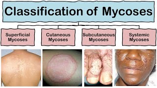 Classification of Mycoses in Hindi  Microbiology  Mycology [upl. by Josi587]