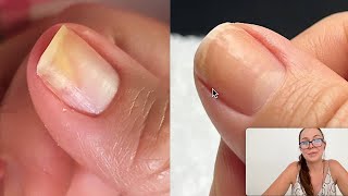 How she regrew her separated nail Onycholysis [upl. by Ziwot804]