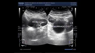 Ultrasound Video showing Ovarian Cysts simple Hemorrhagic and complex ones all in one patient [upl. by Yneffit]