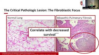 51024  A Mouse Model to Further Elucidate Mechanisms of Idiopathic Pulmonary Fibrosis [upl. by Einiffit40]