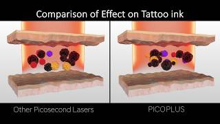 PICOPLUS  highest power picosecond laser [upl. by Aryajay]