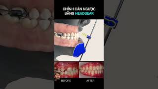 Cp pharmacist braces orthodontics shortvideo dentalclinic anatomy duet doctor braces pharma [upl. by Atram329]