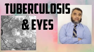 TUBERCULOSIS AND EYES Tuberculosis EyeinfectionRifampicinisoniazidethambutol [upl. by Philender]