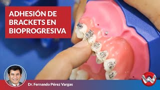 Como Adherir Correctamente los Brackets en la Técnica Bioprogresiva de Ricketts [upl. by Ellenohs]