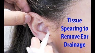 Tissue Spears to Remove Ear Drainage [upl. by Gimble]