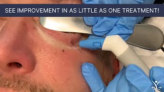 Eye Bag Treatment with RF Microneedling [upl. by Liss697]