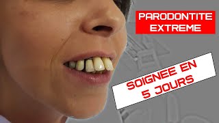 Soigner la parodontite avec perte de gencive  Implants dentaires basales non invasif [upl. by Spears]