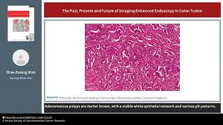 The Past Present and Future of Imaging Enhanced Endoscopy in Colon Tumor [upl. by Akiria]