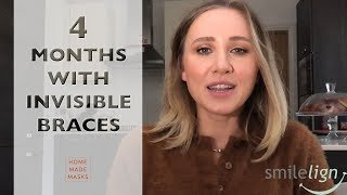 Invisible Braces 4 Months With Smilelign Clear Aligners [upl. by Nwahsek]