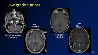 Imaging brain tumors  4  Other low grade gliomas [upl. by Ilamad]