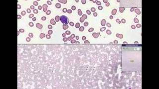 Histopathology Blood Acute leukemia [upl. by Henrion]