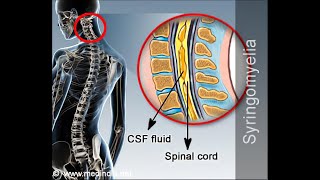 Neuroanatomical Reasons for Signs and symptoms in syringomelia Cavitation of the spinal cord [upl. by Jurdi947]