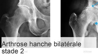 Coxarthrose bilatérale de stade 2  causes symptômes de la maladie méthodes de thérapie [upl. by Nert192]