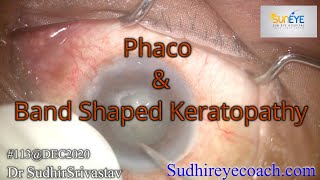 Phaco with Band Shaped KeratopathyDR SUDHIR SRIVASTAVA [upl. by Power]