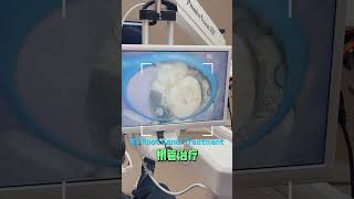 3 Root Canal Treatment 根管治疗 dentistoffice dentalcare dentalclinics doctor [upl. by Anatnas716]