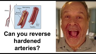 Avoid hardening of the arteries and help reverse it using a simple dietary tweak [upl. by Marga300]