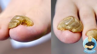 WHY DO TOENAILS GROW LIKE THIS CRAZY LAYERED TOENAILS [upl. by Naujej]