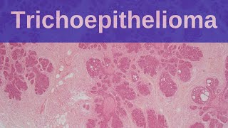 Trichoepithelioma  Pathology mini tutorial [upl. by Yenwat]