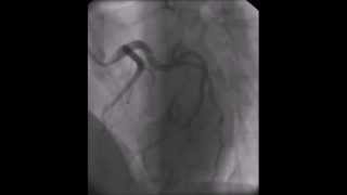 Super dominant left circumflex coronary artery [upl. by Carlie]