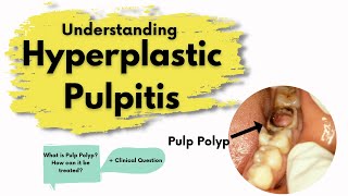 Pulp Polyp Hyperplastic Pulpitis  What is it  Diagnosis Treatment  Endodontics [upl. by Delanos330]