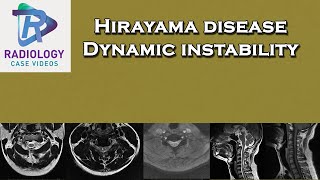 Hirayama disease Dynamic instability [upl. by Connett]