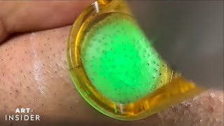 Laser Zaps Out Ingrown Hairs  Art Insider [upl. by Largent315]