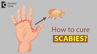 How to cure Scabies  Dr Rajdeep Mysore [upl. by Enerual726]