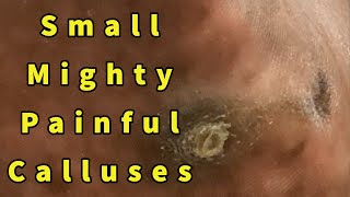 Small Mighty Painful Calluses Intractable Plantar Keratoses Removal  Repost [upl. by Maryrose737]