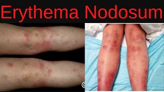 Erythema Nodosum Symptoms Causes Diagnosis Treatment Infections Medications [upl. by Phelips]