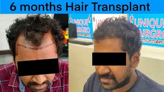 6 month hair transplant result  hair transplant feedback  hair transplant in Chennai [upl. by Polly]