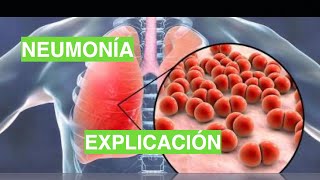 ¿Cómo se produce la Neumonía Fisiopatología de la Neumonía [upl. by Philbrook]