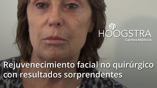 Rejuvenecimiento facial no quirúrgico con Láser de Co2 y Plasma Rico 15032 [upl. by Eppesuig193]