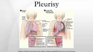 Pleurisy [upl. by Yffub]