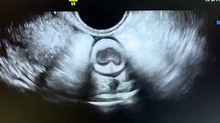 Ultrasound of typical findings of ulcerative colitis in 30 year female [upl. by Chill]